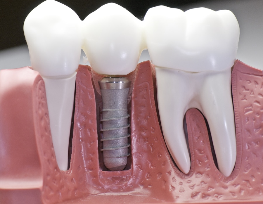 Illustration dental implants